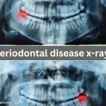 early periodontal disease x-ray
